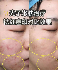 光子嫩肤是不是真的能祛痘印?用我的高清原图来给大家看效果