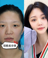 都说我做的双眼皮太成功了!我个人觉得最关键的是医生要找好
