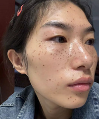 祛斑一年后,给大家看看现在的皮肤状况!脸上真的干净了很多