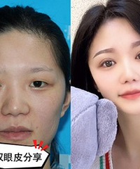 这次做的双眼皮,大家都说很成功