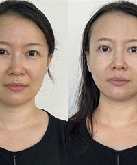 做一次超光子+水光+牛奶光,才199