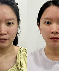 想要缩毛孔的姐妹,黄金微针5代来了!能让皮肤细腻得自己都惊讶