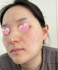 祛斑有多容易,看我就知道了!现在皮肤好干净
