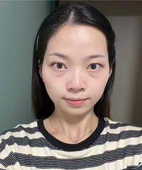 眼袋太大,26岁被人以为是36岁!祛眼袋之后,年轻回来了