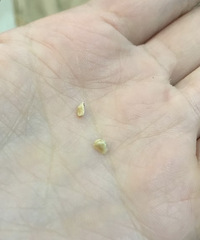 长牙结石的人,你们是怎么处理的?