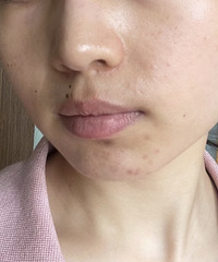 看我做了2次水光的皮肤变化,这效果真的太好了