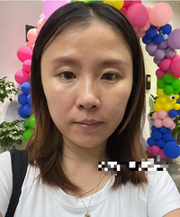 法令纹太重了,脸太垮了,还是去尝试了超声炮,效果好惊人