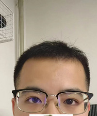 我和弟弟都选择这家医院做了近视手术,恢复很好