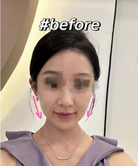 产后垮脸真的好严重!做了一次黄金超声炮,就恢复了很多