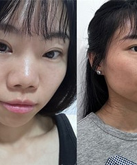新出的黄金微针5.0,我帮你们体验了