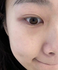 不吹不黑,做了黄金微针,皮肤真的能够越来越好!看我就知道了