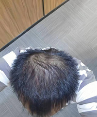 脂溢性脱发七八年,用了这个方法,终于长头发了