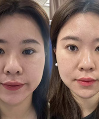超声炮真的太适合肉肉脸了,15天后看起来真的紧致了不少