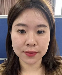 超声炮还是肉肉脸更合适,我打了快2月,有效果