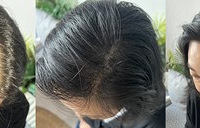 一步实现“换头”!3小时,宽发缝就这么没了