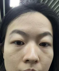 填充泪沟除了贵,个人觉得没有任何缺点了!瞬间就让我变得好年轻
