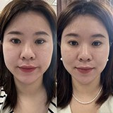 超声炮真的适合肉肉脸