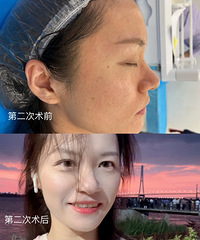 做2次黄金微针,皮肤真的有了很大的变化!毛孔小了,也不卡粉了