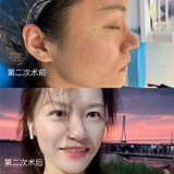做2次黄金微针的变化