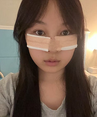 祛掉了眼袋和泪沟,现在拍照不用P图,都好看又年轻
