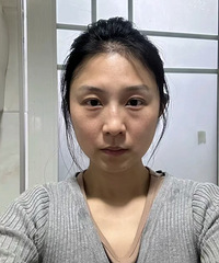 祛眼袋其实也可以不用动刀,做了之后,朋友都说我像年轻5岁