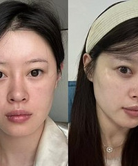 这个项目缩毛孔真的绝了,亲测后很推荐