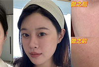 这个项目缩毛孔不痛,效果还好,亲测后很推荐