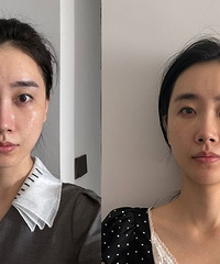 我做了比黄金微针还厉害的黑金微针,能解决12种皮肤问题