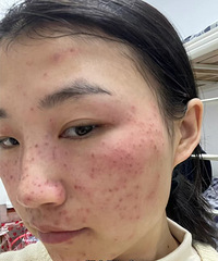 祛斑真的很简单,分享我10天恢复期的全过程,一天天更好