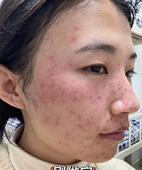 祛斑真的很简单,分享我10天恢复期的全过程,一天天更好