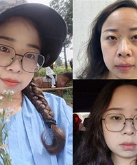 祛掉眼袋之后,肉眼可见的年轻了