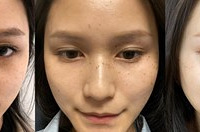 只做了4次皮秒祛斑,现在皮肤好干净