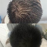 脱发8年,又长回来了