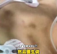 尸检证实男童被生父女友虐待致死