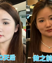 超声炮真能让肉肉脸变小脸,这个抗衰项目不踩雷