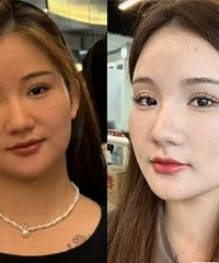 没踩雷!肉肉脸真的很适合做超声炮