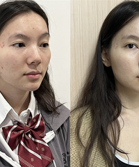 这个敏感肌都能做的黄金微针,能修复屏障,缩小毛孔,细腻皮肤