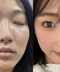 这是我试遍了各种方法后,总结出来,对付痘坑痘印效果最好的