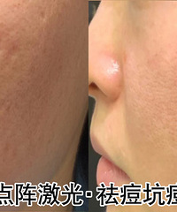 这是我试遍了各种方法后,总结出来,对付痘坑痘印效果最好的