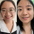 高度近视说说近视手术