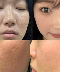 用这个方法,就能解决痘坑痘印