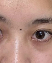 祛眼袋10天,差别真的很大!总结了眼袋面诊的必问十大问题