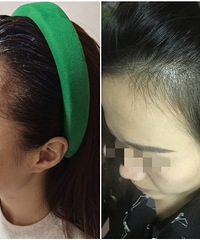 用这个长头发的方法3个月,发际线是真的长了好多杂毛起来