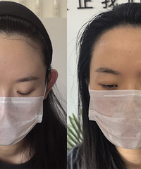 轻松“长”出发际线的方法来了!只要3小时,拯救你的大脑门