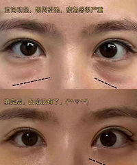 真能淡化黑眼圈和泪沟凹陷,不信来看看我的效果