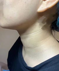 嗨体祛颈纹的效果,是真的立竿见影!一次就淡化了这么多