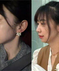 下巴后缩太严重,改变后连气质都变了