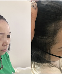 年龄越大,掉发就越严重!用3个月时间,不植发也长出发际线