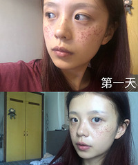 记录祛斑恢复期的全过程,一共14天,脸一天比一天更干净
