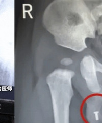 8个月男婴“蛋蛋”内惊现螺丝钉?